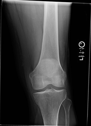 Vacuum Phenomenon In The Knee 