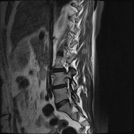 Annular fissure | Radiology Case | Radiopaedia.org