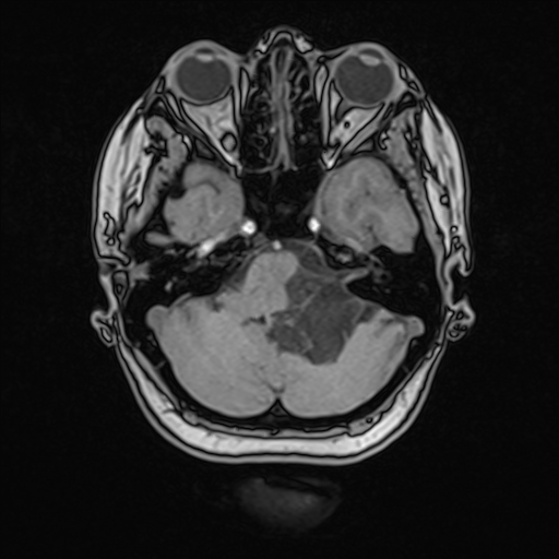 Cerebellopontine Angle Epidermoid Cyst Image 5986