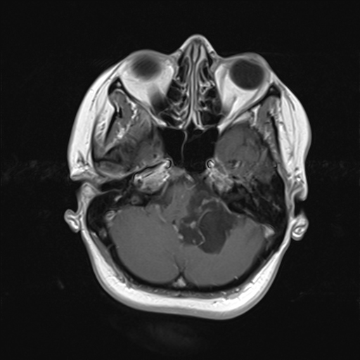 Cerebellopontine Angle Epidermoid Cyst Image 5145