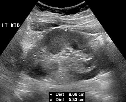 Dromedary hump | Image | Radiopaedia.org