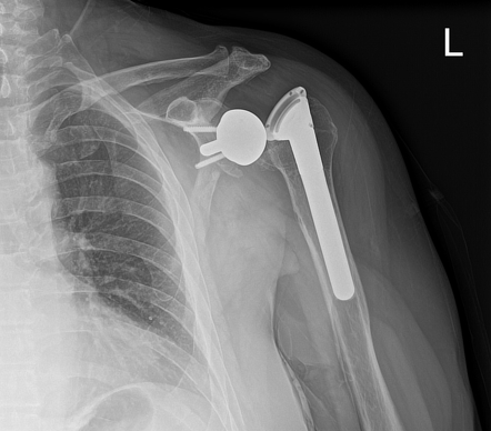 Reverse total shoulder arthroplasty with polyethylene liner ...