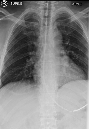 Kinked nasogastric tube | Image | Radiopaedia.org