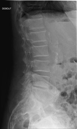 Paget disease | Image | Radiopaedia.org