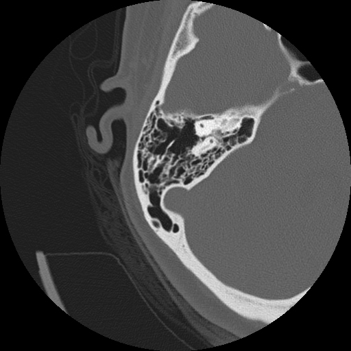 Otosclerosis Radiopaedia