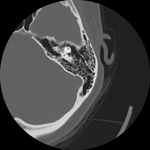 Fenestral otosclerosis | Image | Radiopaedia.org