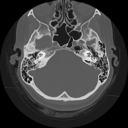 Fenestral otosclerosis | Radiology Case | Radiopaedia.org