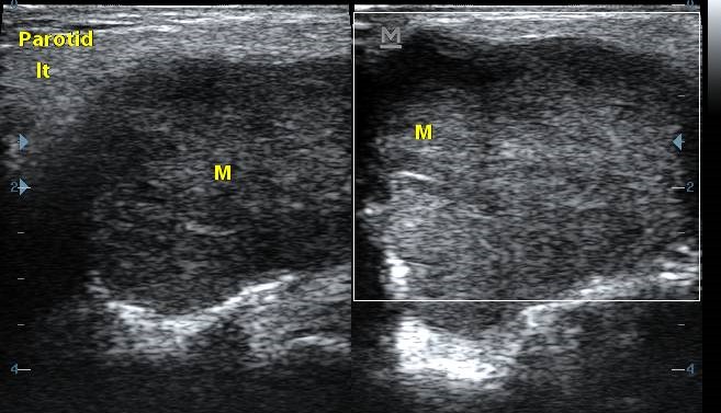 Pleomorphic Adenoma Parotid Gland Image