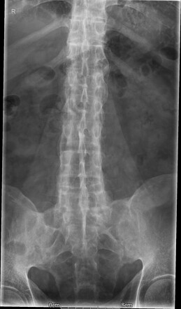 Ankylosing Spondylitis Radiology Case Radiopaedia Org