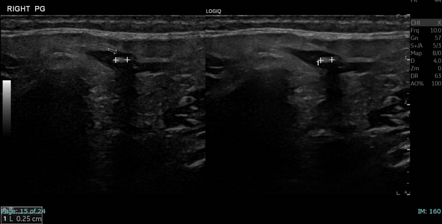 Parotid duct stone | Radiology Case | Radiopaedia.org