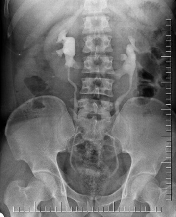 Horseshoe kidney, Radiology Reference Article