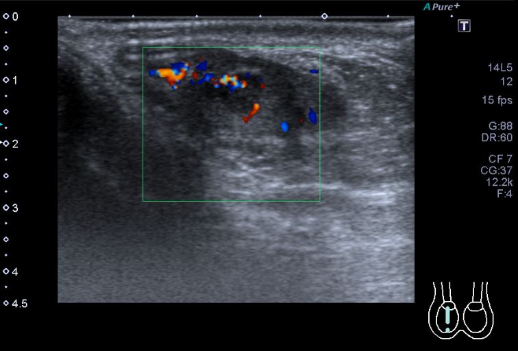 Testicular Adrenal Rest Tumor Tart Image