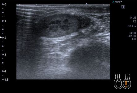 Testicular adrenal rest tumor (TART) | Image | Radiopaedia.org