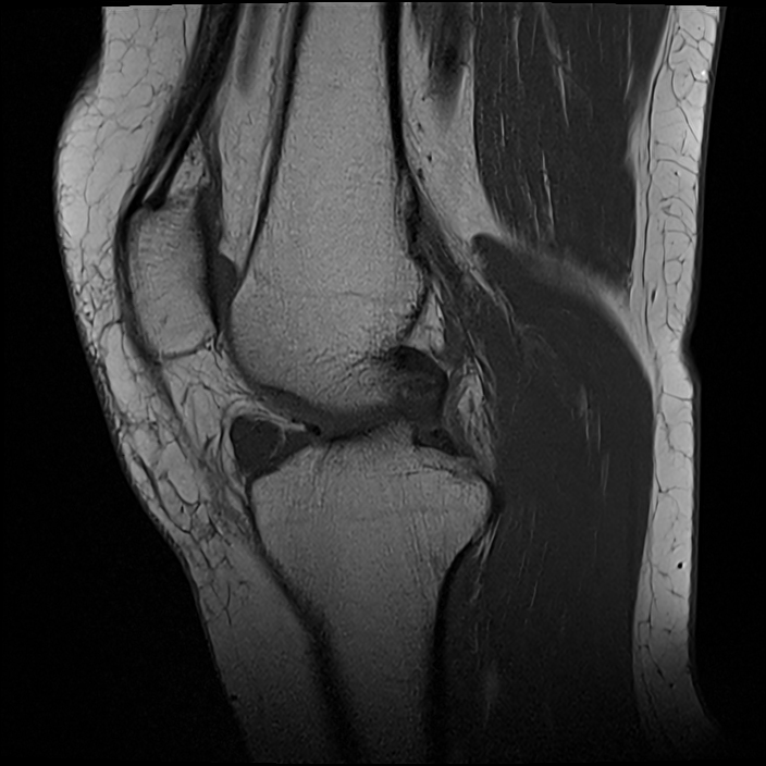 Hoffa fat pad ganglion cyst | Image | Radiopaedia.org