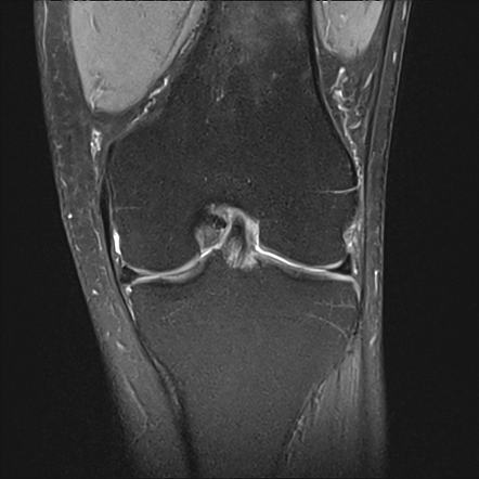 Inferiorly displaced flap tear of medial meniscus | Radiology Case ...