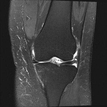 Medial meniscus posterior root tear | Radiology Case | Radiopaedia.org