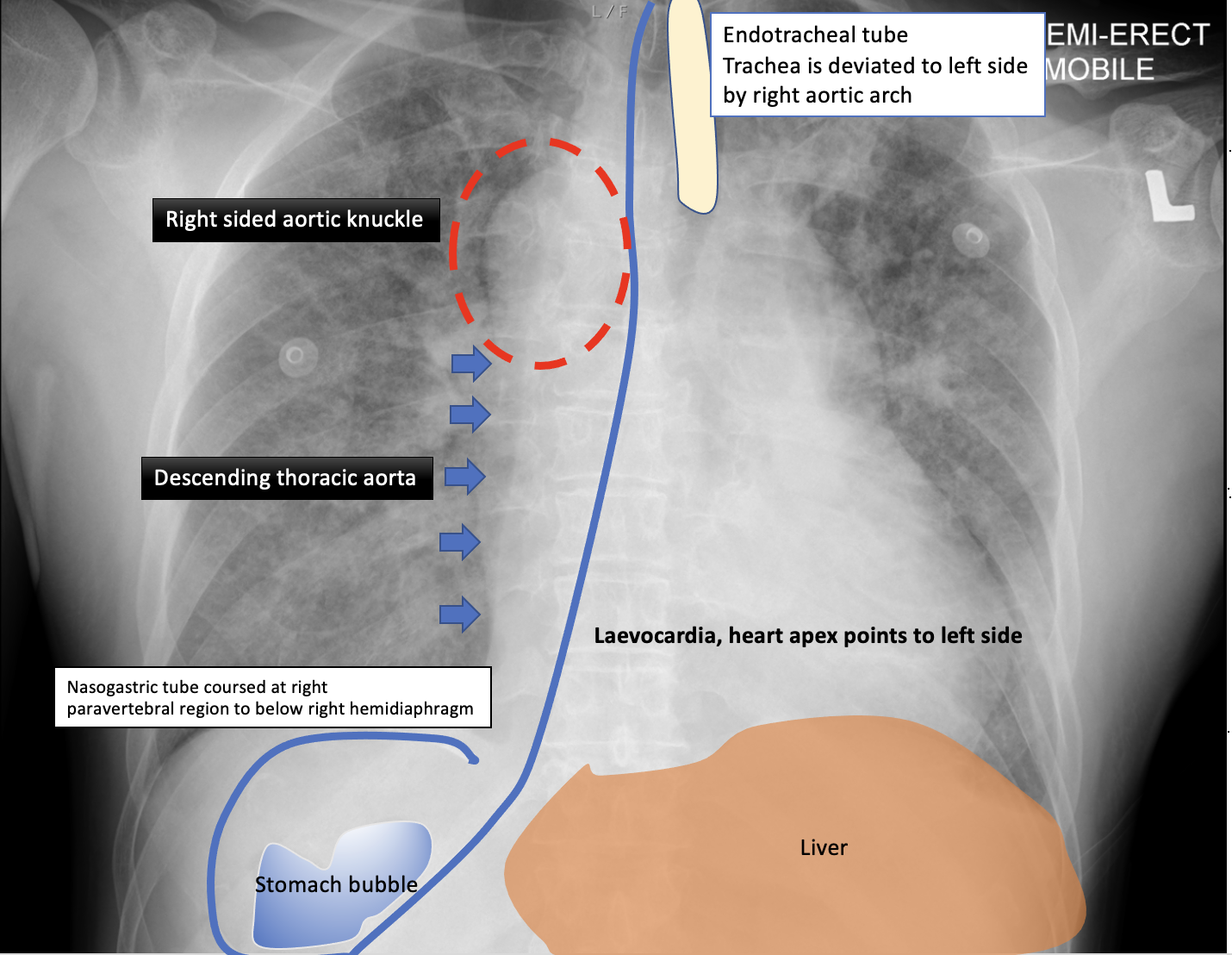 Situs ambiguus - left isomerism | Image | Radiopaedia.org