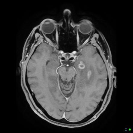 Glioblastoma | Radiology Case | Radiopaedia.org