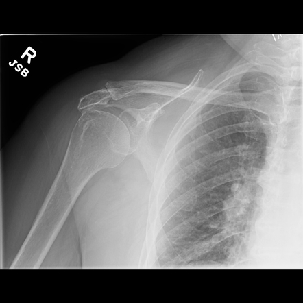 Subacromial spur | Image | Radiopaedia.org