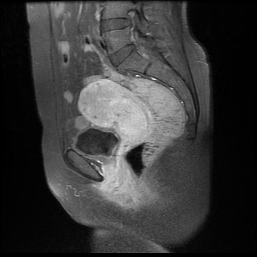 Prolapsed Endometrial Polyp Image