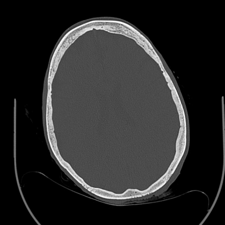 Occipital Bone Osteomyelitis 