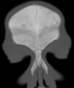 pterygopalatin sütür