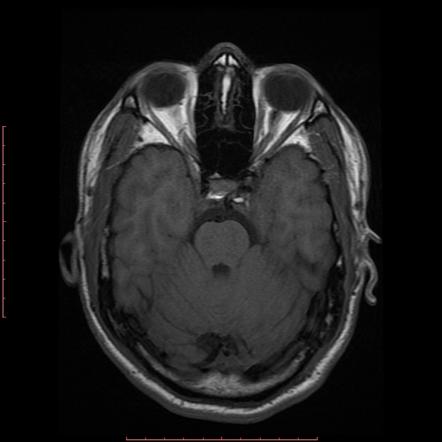 Persistent trigeminal artery - Saltzman type I | Image | Radiopaedia.org