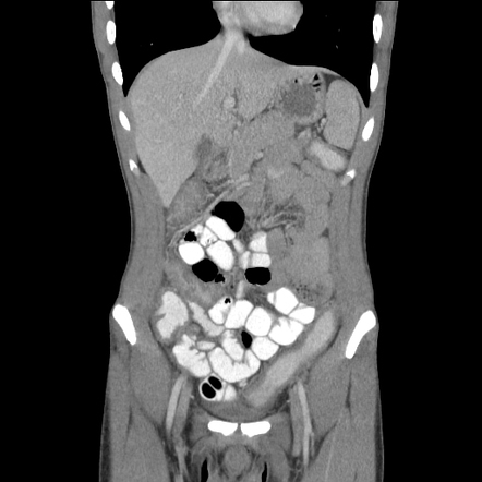 Ulcerative colitis - pancolitis on presentation | Radiology Case ...