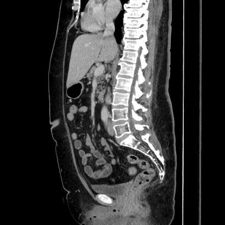 Acute cholecystitis - tensile fundus sign | Image | Radiopaedia.org