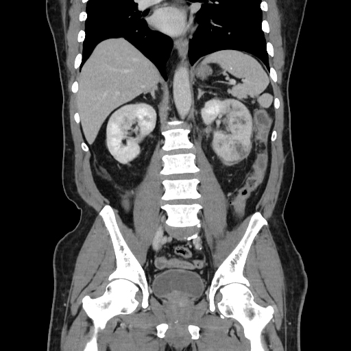 Severe pyelonephritis with abscesses | Image | Radiopaedia.org