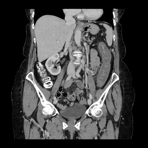 Nonocclusive Ischemic Colitis Image