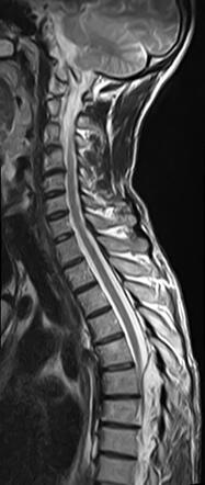 Spinal epidural hemangioma | Image | Radiopaedia.org