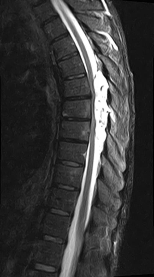 Spinal epidural hemangioma | Image | Radiopaedia.org