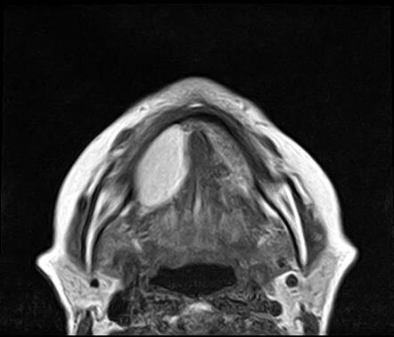 Lipoma - mouth floor | Radiology Case | Radiopaedia.org