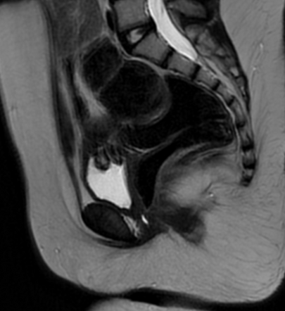 Gonadal and mullerian agenesis | Radiology Case | Radiopaedia.org