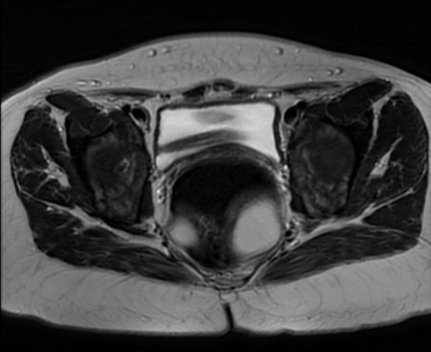 Gonadal and mullerian agenesis | Image | Radiopaedia.org