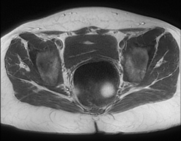 Gonadal And Mullerian Agenesis Image