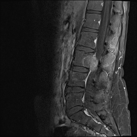 Spinal chordoma | Radiology Case | Radiopaedia.org