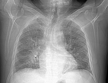 Cardiogenic Pulmonary Edema Radiology Case Radiopaedia Org