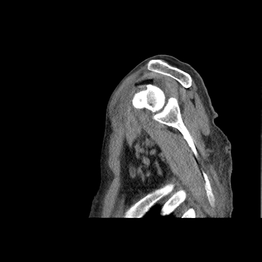 Lipohemarthrosis Of The Shoulder Image