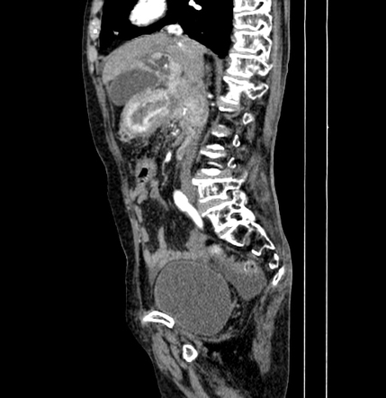 Gastro-duodenal Intussusception 