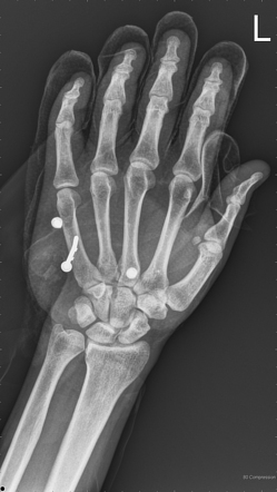 Nail gun injury to the hand | Radiology Case | Radiopaedia.org