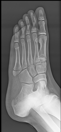 Jones fracture | Radiology Reference Article | Radiopaedia.org