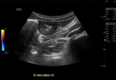 Duodenal Thickening Secondary To Iga Vasculitis 