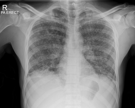 case study of miliary tuberculosis