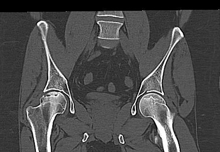 Avascular Necrosis Of The Femoral Heads | Radiology Case | Radiopaedia.org