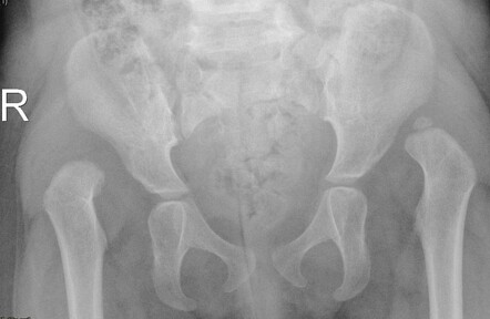 Developmental dysplasia of the hip | Radiology Case | Radiopaedia.org