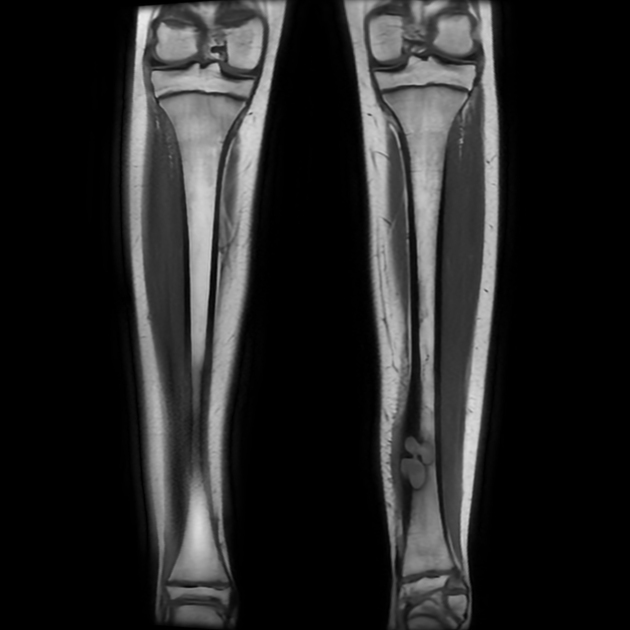 Brodie abscess Radiology Case Radiopaedia