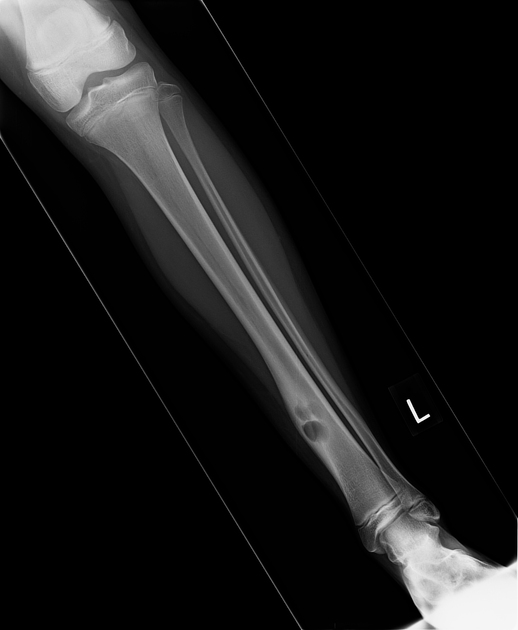 Brodie abscess Radiology Case Radiopaedia