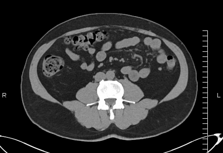 Calyceal diverticulum | Radiology Case | Radiopaedia.org